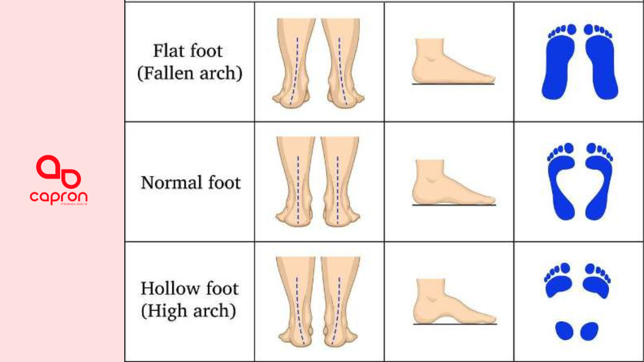 macam macam bentuk kaki berdasarkan kelengkungan